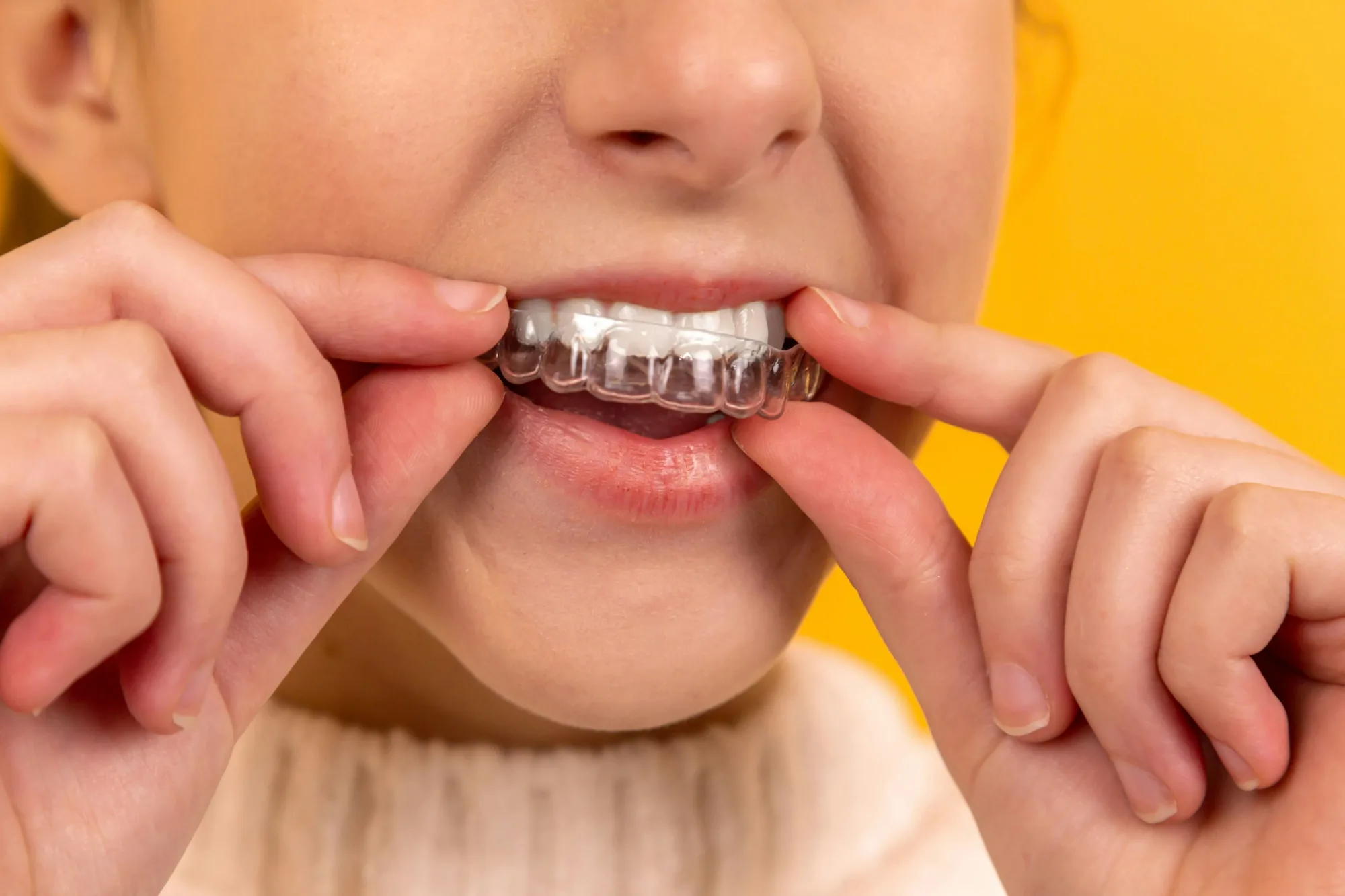 A patient placing a clear
    orthodontic aligner