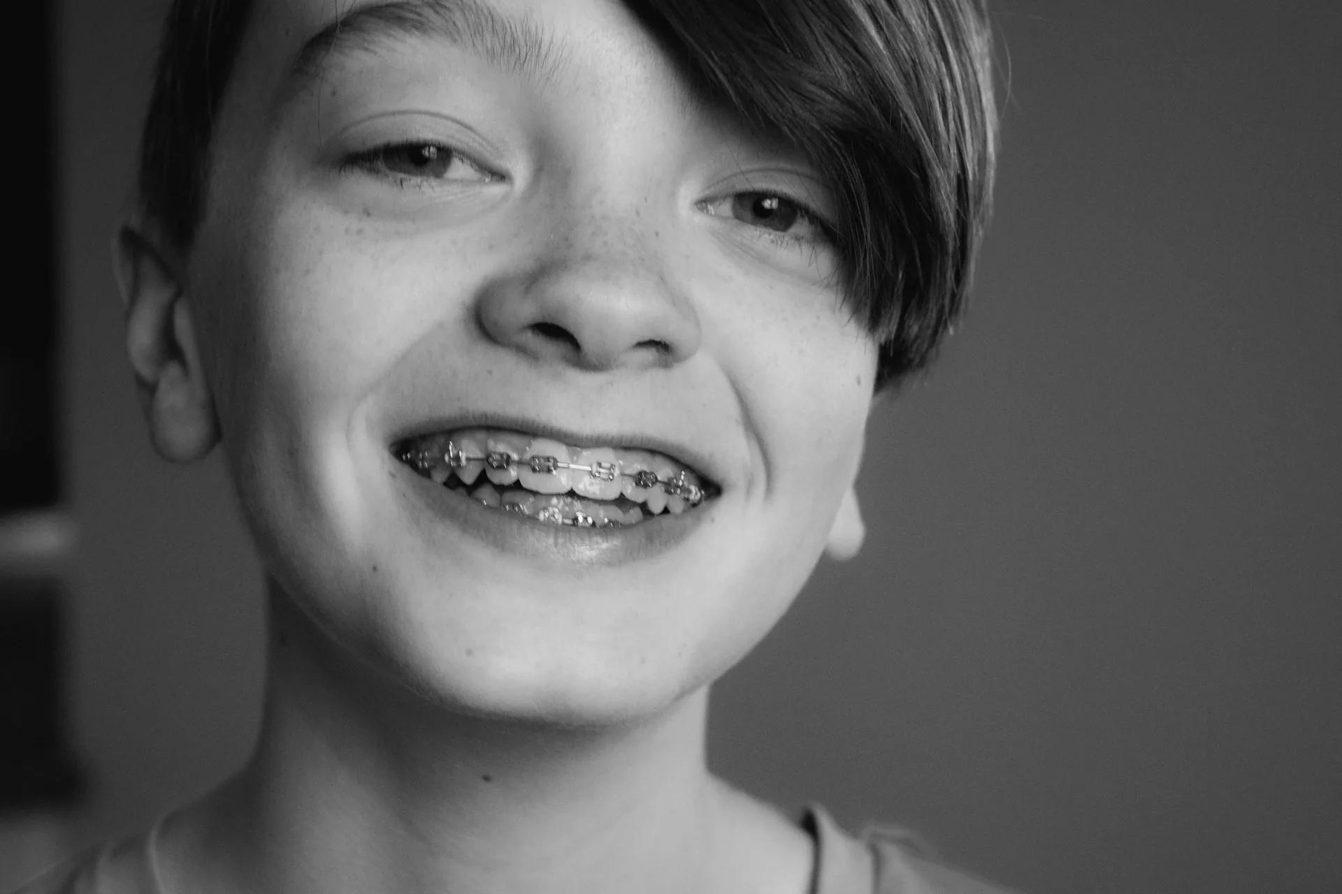 A close-up smile showing fixed braces — brackets bonded to the teeth with an archwire running through them