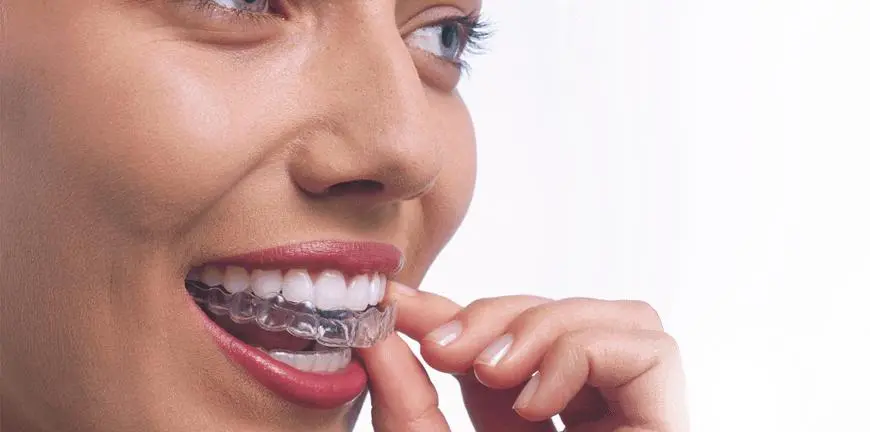 A patient placing a clear Invisalign aligner over her upper teeth